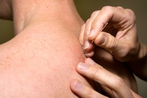 Redwood Physiotherapy Clinic offers acupuncture as one of many treatment options