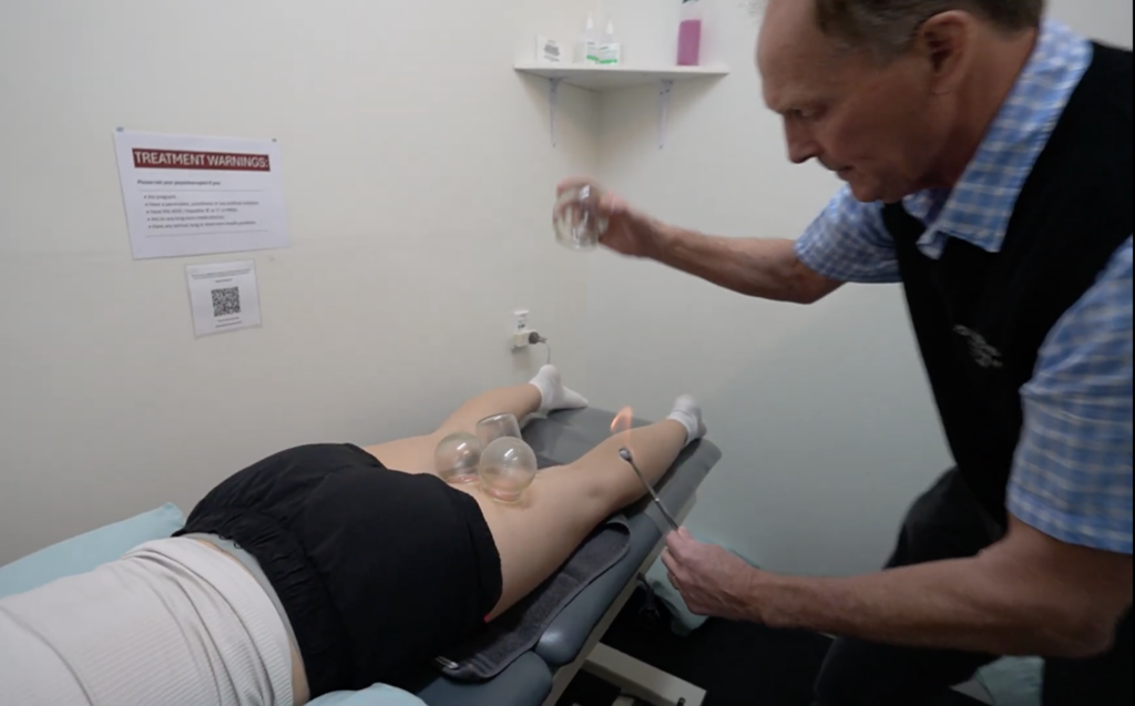 Cupping Treatment in Redwood Clinic Chch